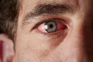 Causes of Conjunctivitis and How to Treat it