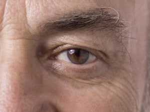 Droopy Upper Eyelid Conditions and Cures
