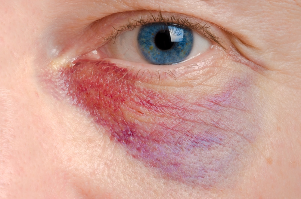 Eye Injuries From Falls Increasing as Population Ages, But Are Often Preventable