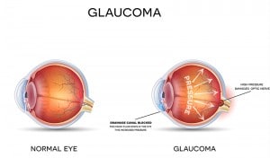 Save Your Vision: Glaucoma Awareness